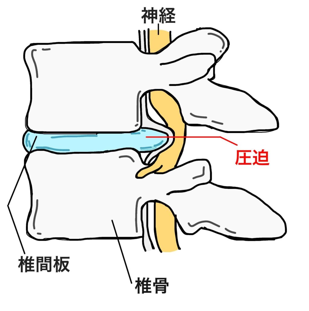 脊柱管狭窄症