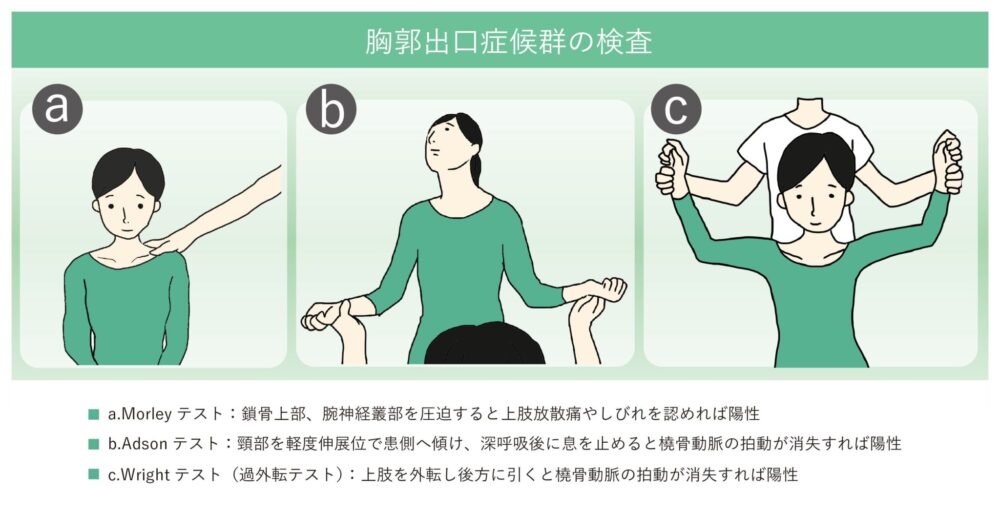 胸郭出口症候群の種類