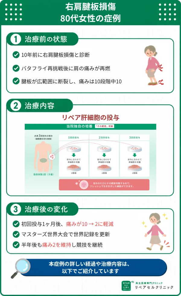 肩の痛みに対する再生医療の症例