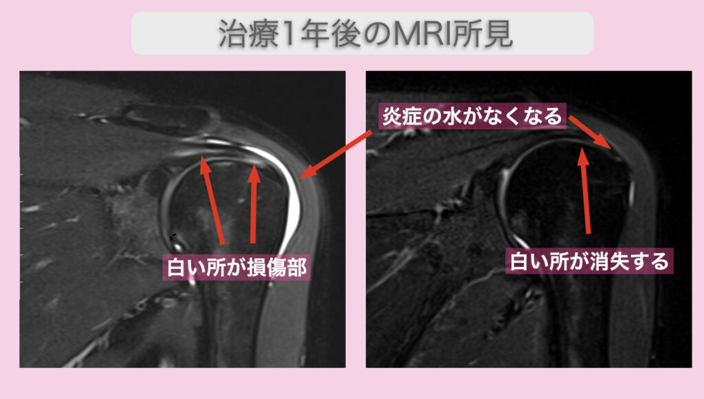 腱板損傷画像診断 – 腱板損傷と断裂の違い – WQHUET