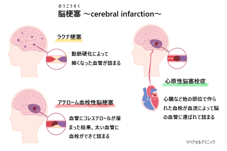 血栓の症状