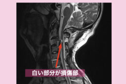 脊椎損傷MRI