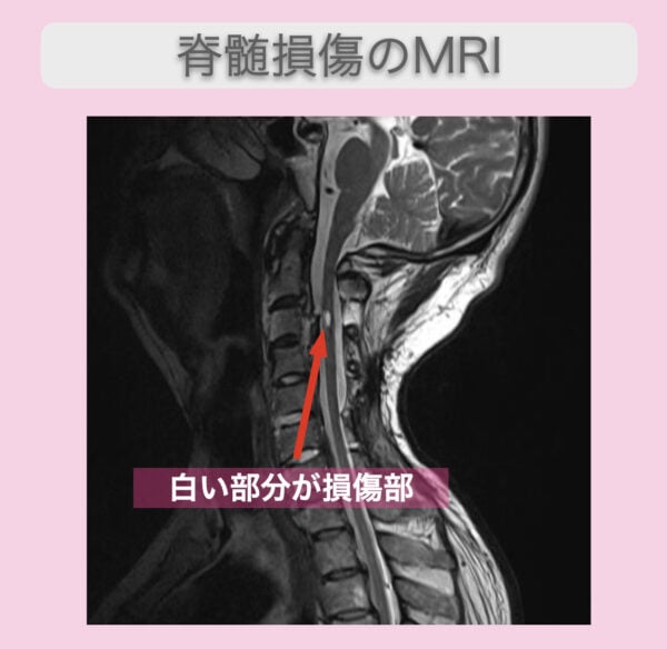 脊椎損傷のMRI画像