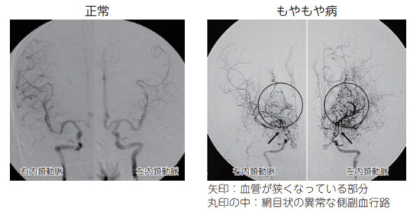 もやもや病の平均余命