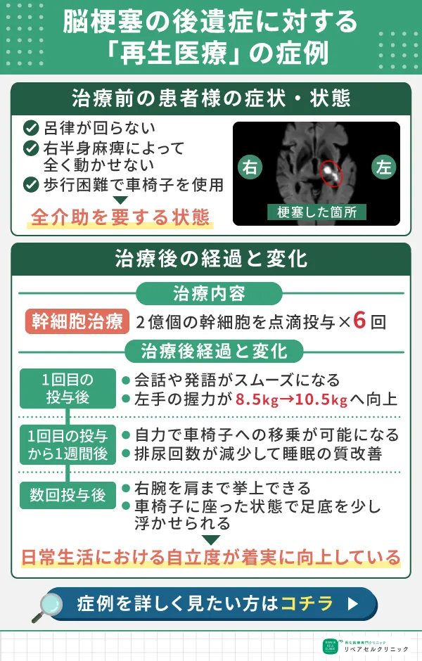 脳梗塞　症例