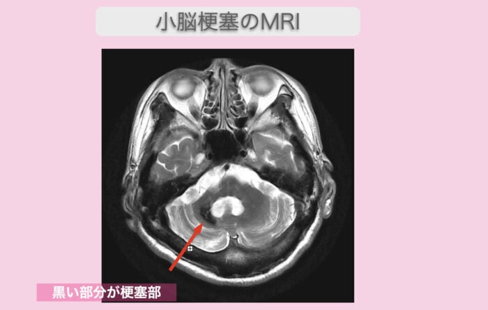 小脳梗塞のMRI　2023-07-07 15.50.25