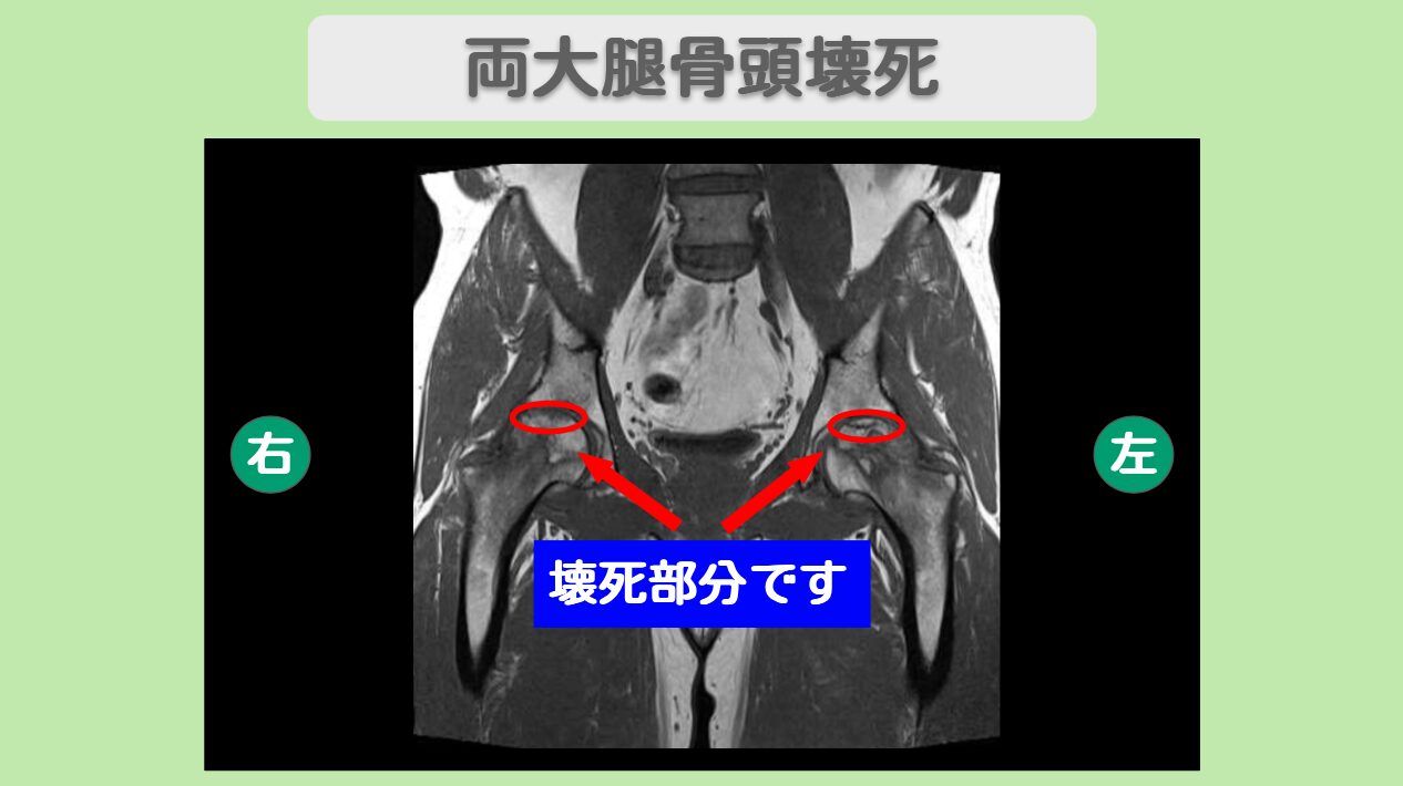 大腿骨頭壊死による痛みが激減！