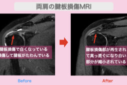 両肩の腱板損傷MRI 2023-08-24 11.22.17