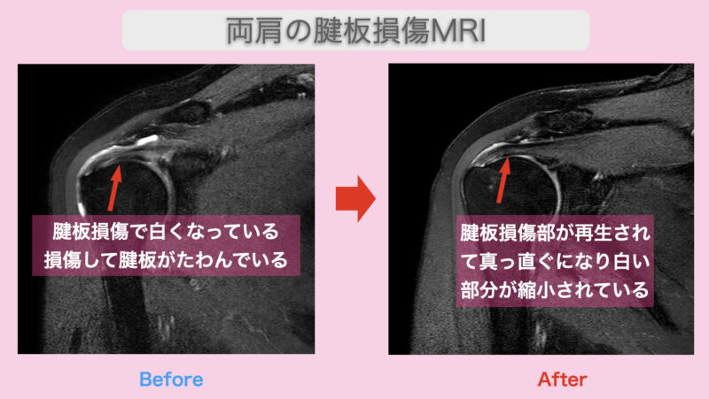 肝臓のMRI検査ってどんな感じですか?