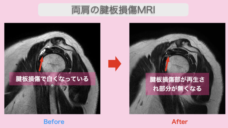 両肩の腱板損傷MRI2 2023-08-24 11.24.56