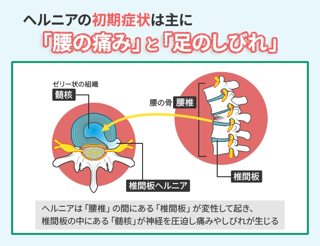 ヘルニアの初期症状は主に「腰の痛み」と「足のしびれ」