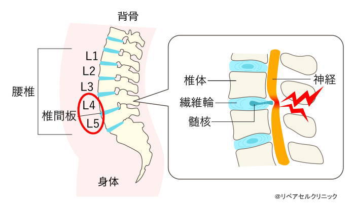 腰椎椎間板ヘルニアの概念図