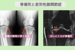 骨壊死と変形性膝関節症