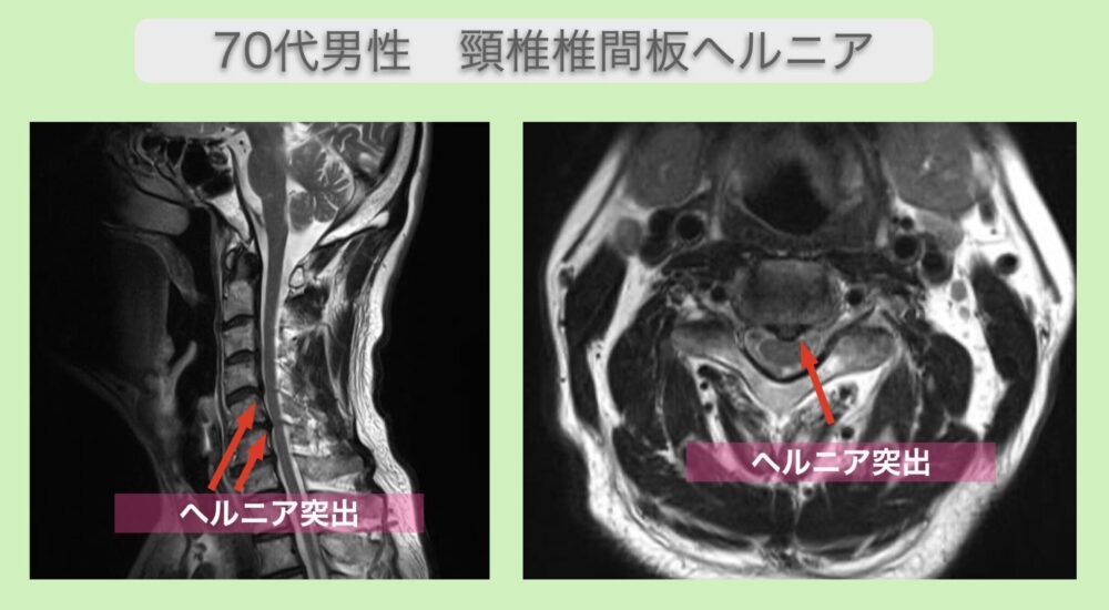 頸椎椎間板ヘルニア