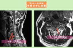 頸椎椎間板ヘルニア　幹細胞治療