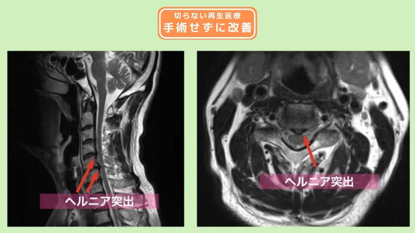 頸椎椎間板ヘルニア 幹細胞治療