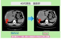 脂肪肝の幹細胞治療でγ―ＧＴＰが半減！　40代男性