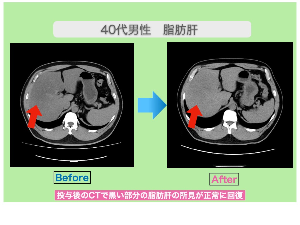 脂肪肝の幹細胞治療でγ―ＧＴＰが半減！　40代男性