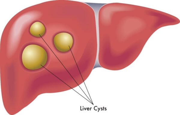 肝嚢胞