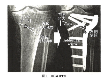 Hybrid closed wedge HTO（HCWHTO）～ハイブリッド式高位脛骨骨切り術～