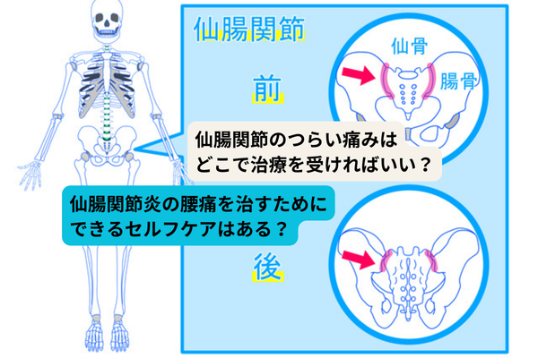 仙腸関節炎の治療法と自宅ケア！痛みを和らげる実践的アプローチ