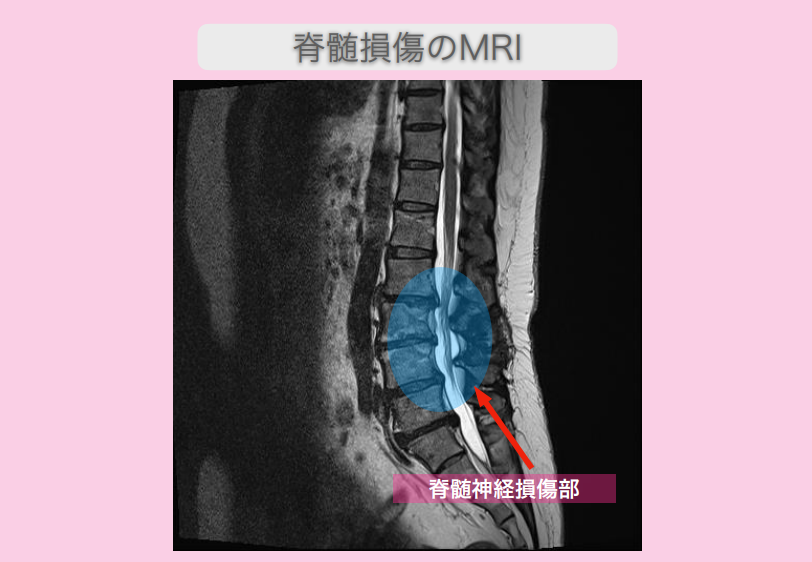 腰椎ヘルニア　幹細胞治療