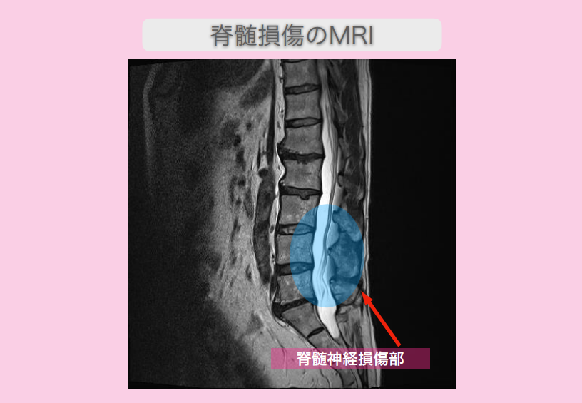 腰椎ヘルニア術後　幹細胞治療