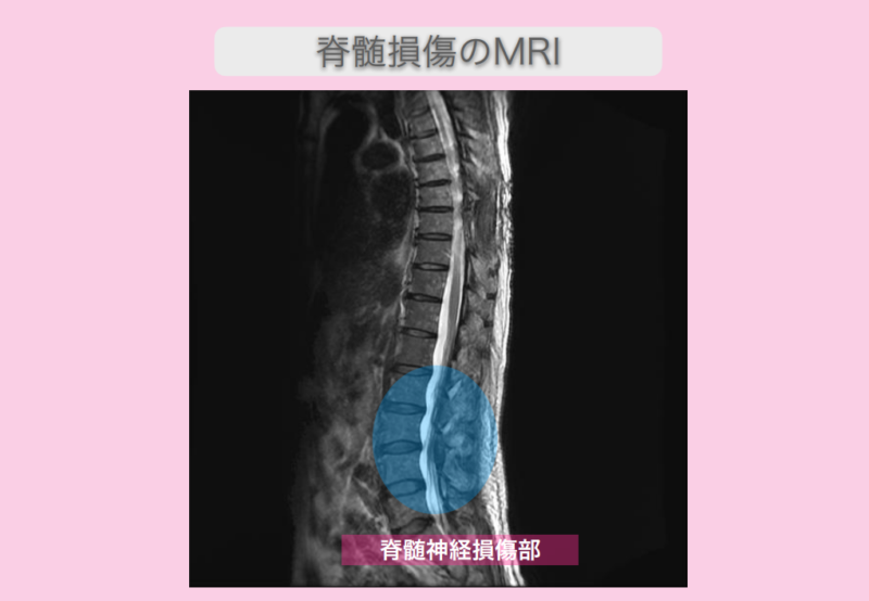 頚椎症性脊髄症　幹細胞治療　80代男性