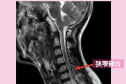 頚髄損傷　幹細胞治療　50代男性