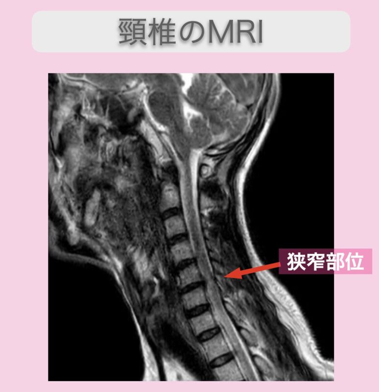 頚髄損傷　幹細胞治療　50代男性