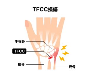 TFCC損傷