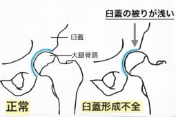 臼蓋形成不全