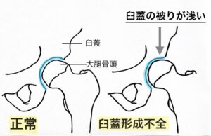 臼蓋形成不全