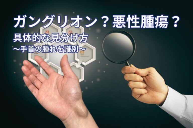 【画像付き】ガングリオンと悪性腫瘍の見分け方！症状やしこりの特徴 …