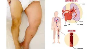 深部静脈血栓症（しんぶじょうみゃくけっせんしょう） 膝から下が痛い 原因