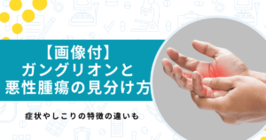 【画像付き】ガングリオンと悪性腫瘍の見分け方！ …