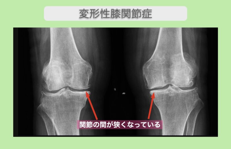 両変形性膝関節症 幹細胞治療 70代女性