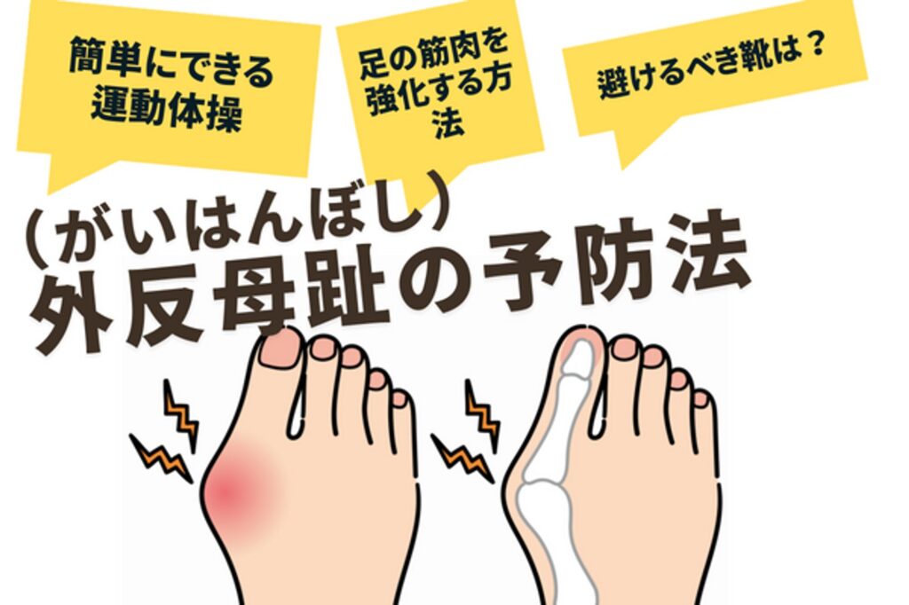 prevention of bunions 1