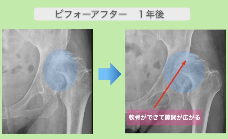 左変形性股関節症　幹細胞治療　50代女性