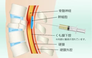 脊柱管狭窄症 手術 後遺症 再生医療