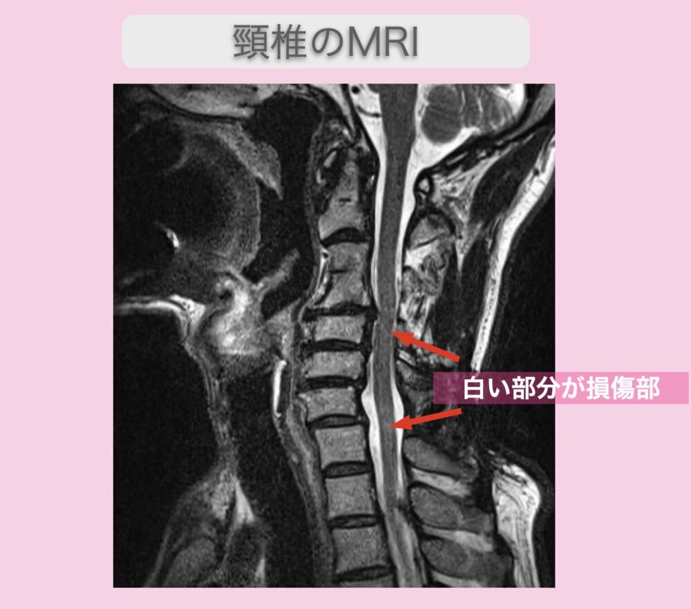 頚椎症性脊髄症　幹細胞治療　70代男性