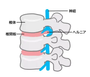 頚椎椎間板ヘルニア