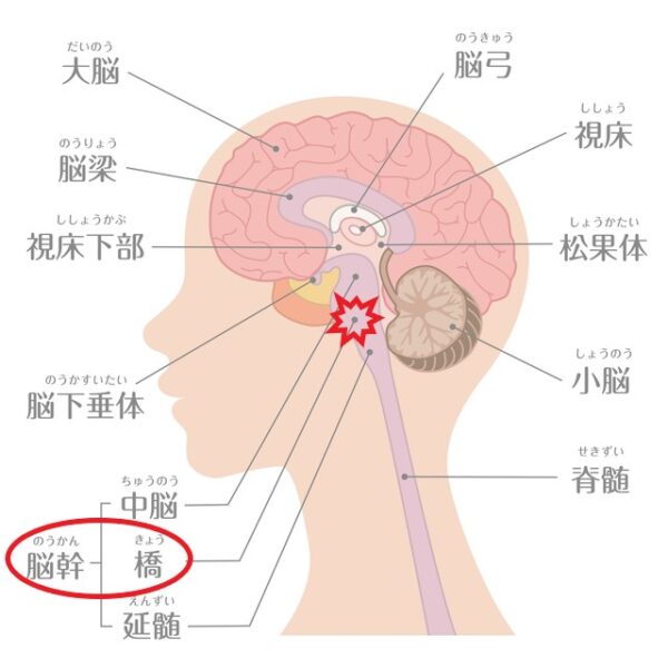 橋出血構造