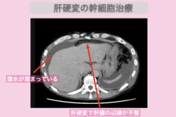 肝硬変　50代男性