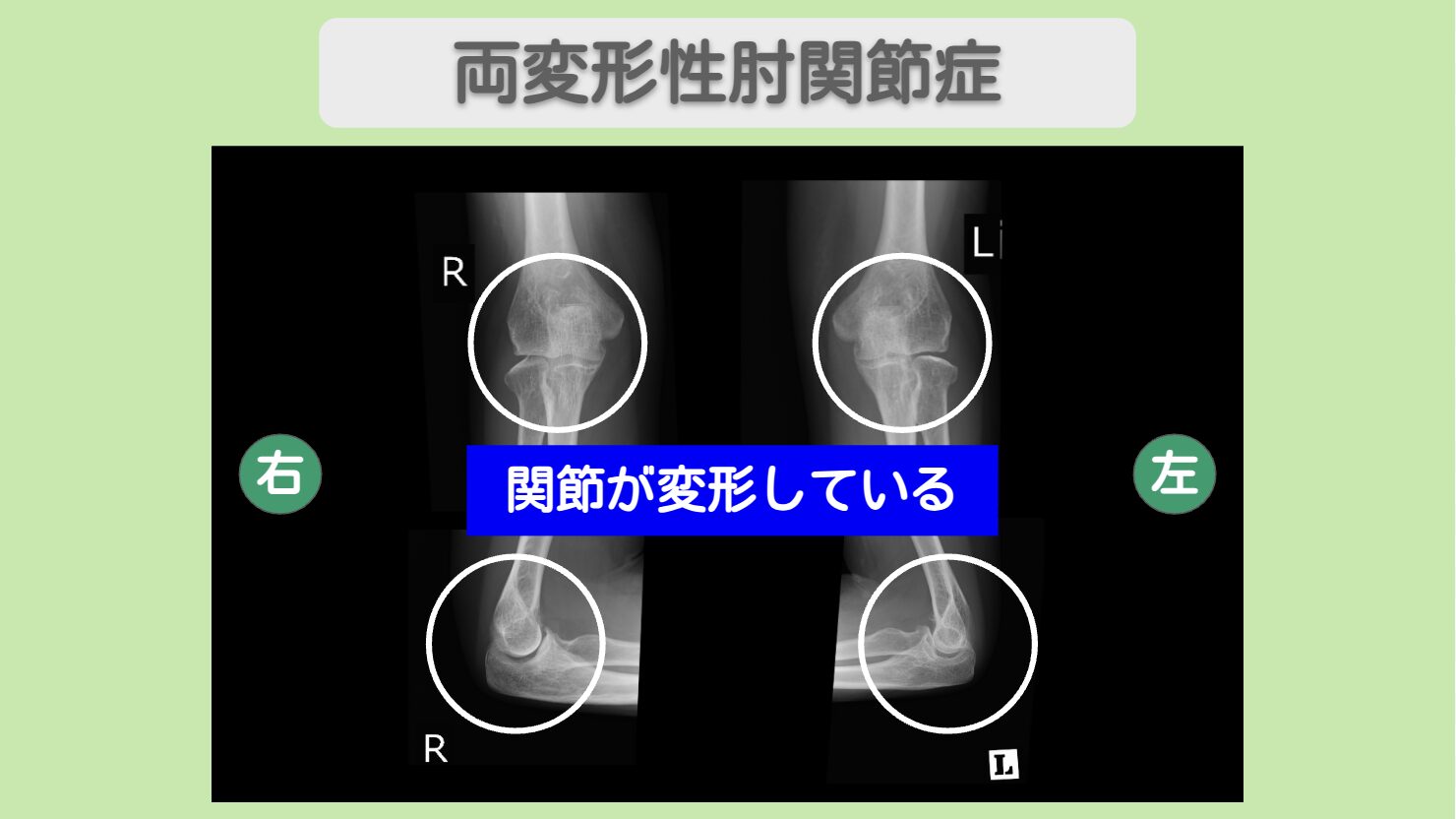 両肘関節症 幹細胞治療 