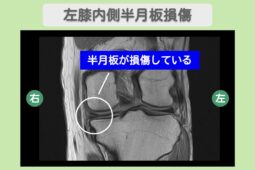 左半月板損傷 幹細胞治療