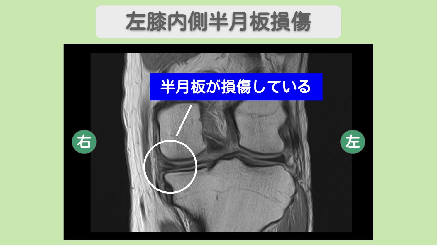 左半月板損傷 幹細胞治療