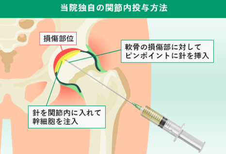 軟骨が最も損傷している箇所を特定しピンポイントに幹細胞を注入