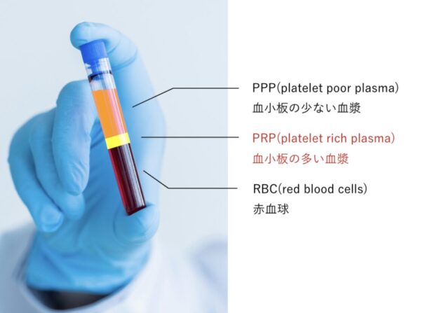 PRP治療