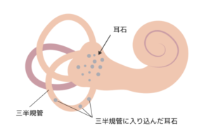 めまいについて医師が説明